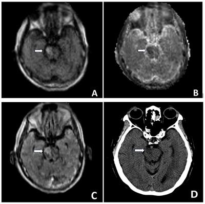 Current role of portable MRI in diagnosis of acute neurological conditions